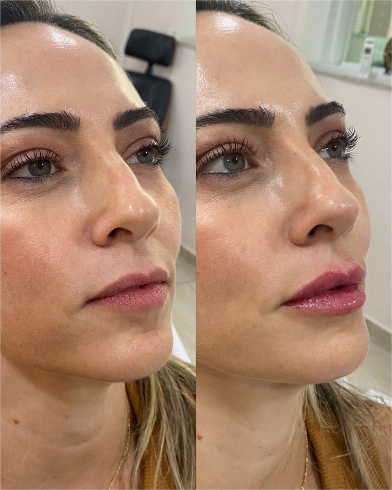 Resultado de harmonização facial — antes e depois 2