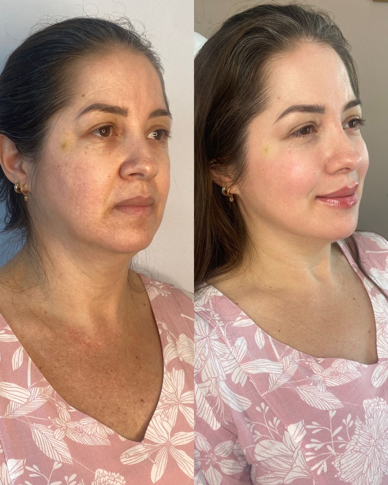 Resultado de harmonização facial — antes e depois 1