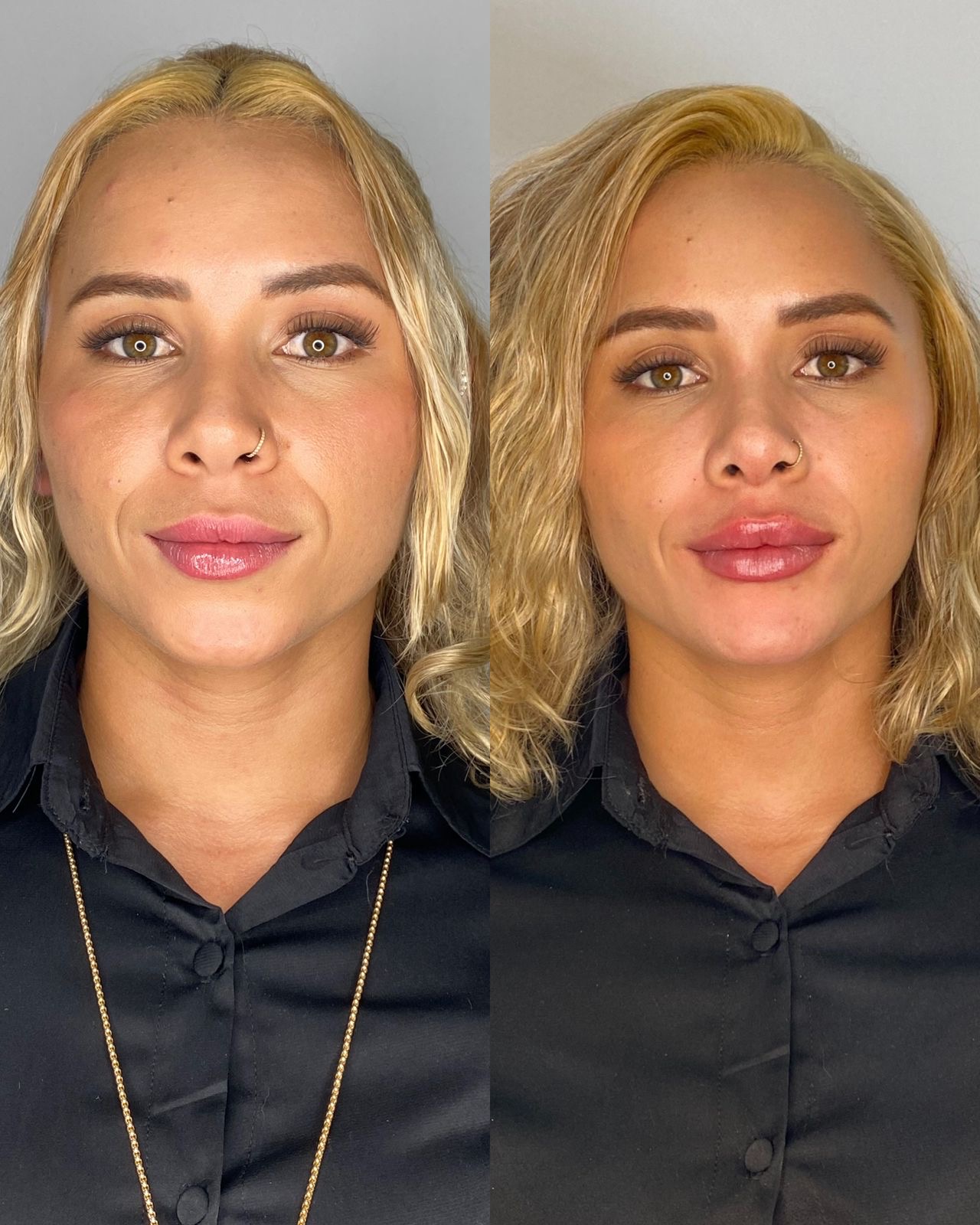 Resultado de harmonização facial — antes e depois 3