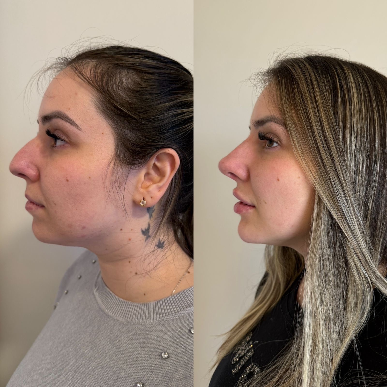 Resultado de harmonização facial — antes e depois 4