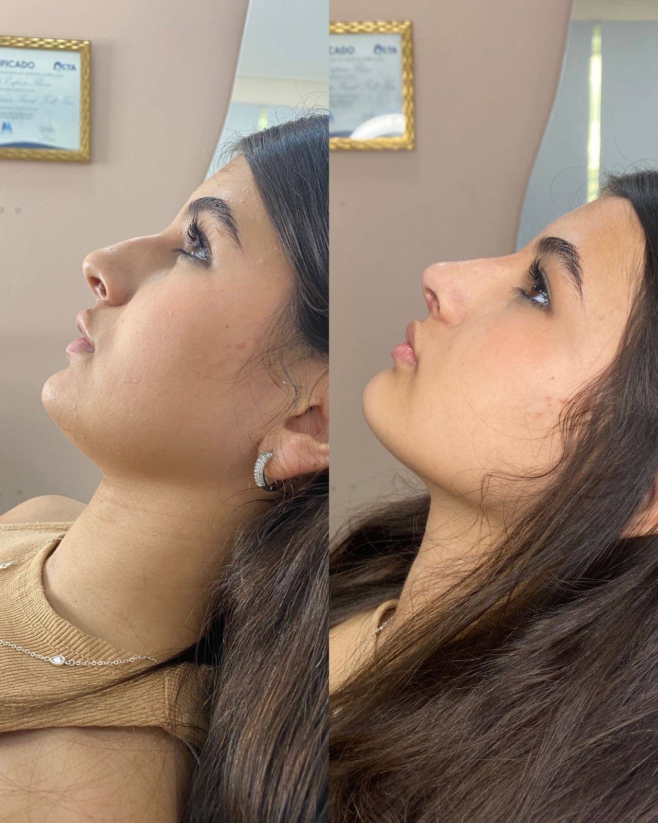 Resultado de harmonização facial — antes e depois 5