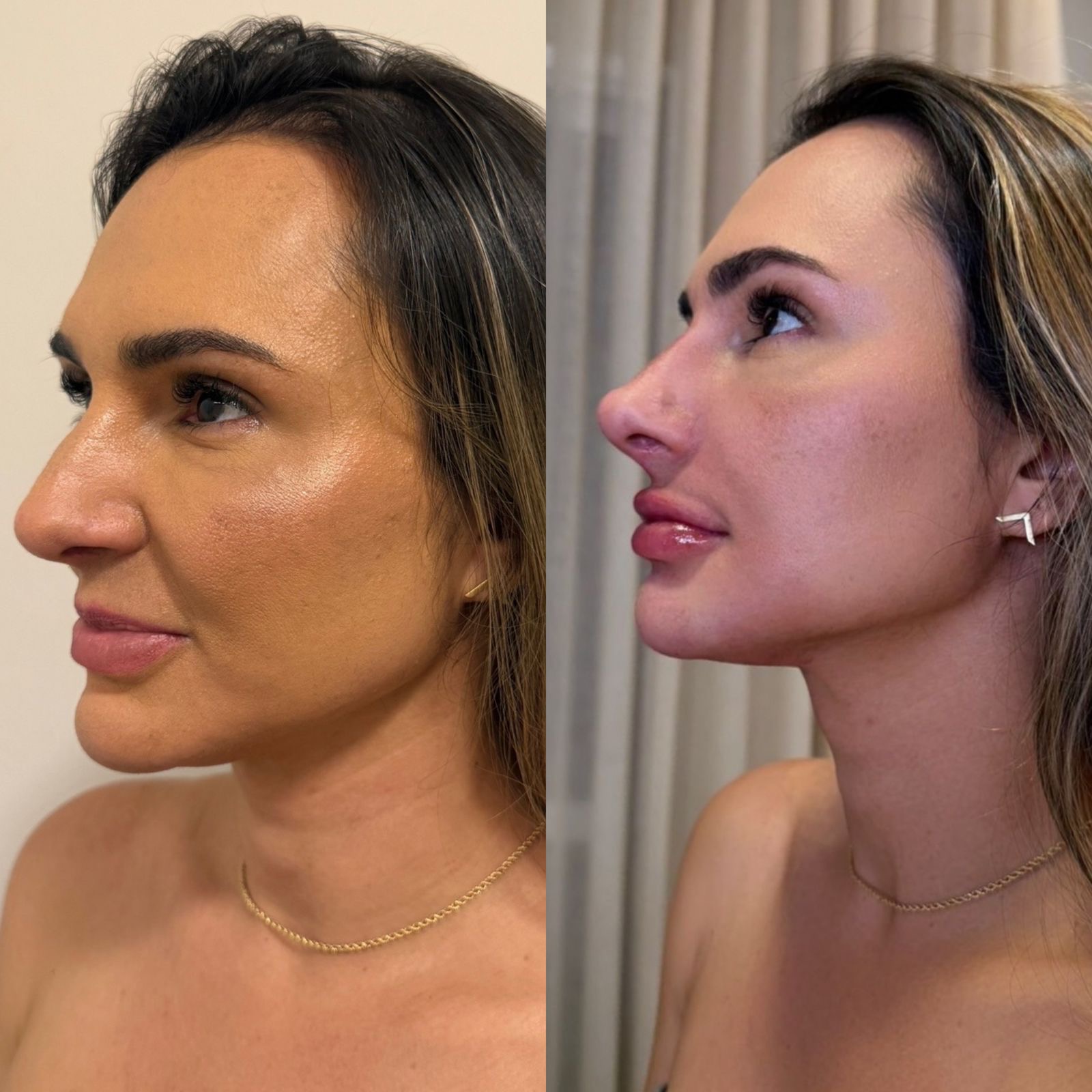 Resultado de harmonização facial — antes e depois 6